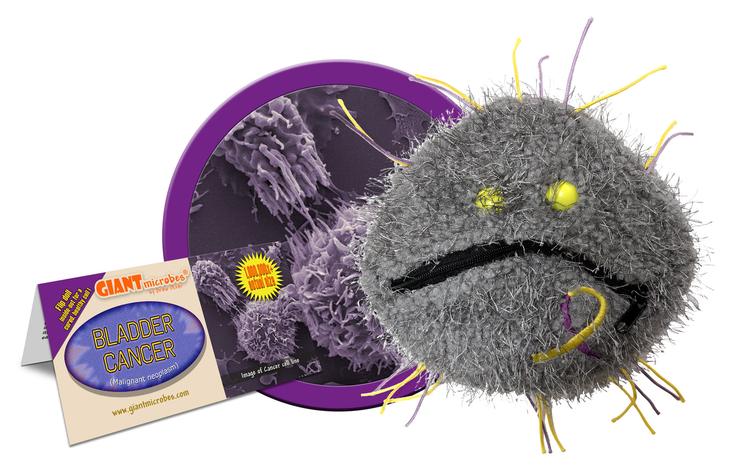Bladder Cancer (Malignant Neoplasm)