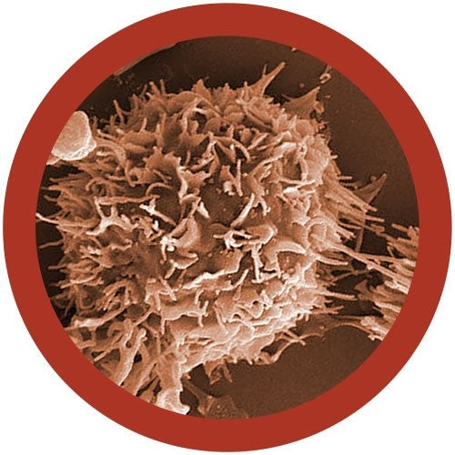 Kidney Cancer
