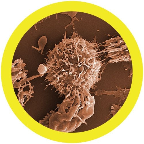 Leukemia (Malignant Neoplasm)