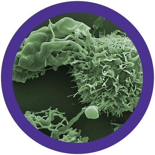 Lymphoma (Malignant Neoplasm)